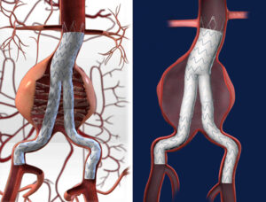 ステントグラフト治療